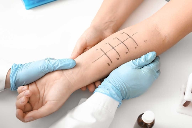 A person's arm preparing for an allergy test